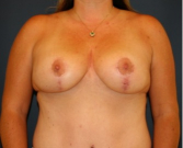 Feel Beautiful - Breast Lift 303 - After Photo